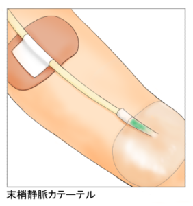 カテーテルのイラスト